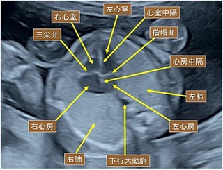 胎児の心臓のエコー写真